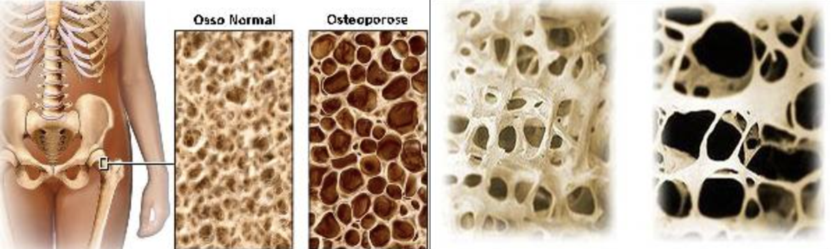 Osteoporose AZ Klina